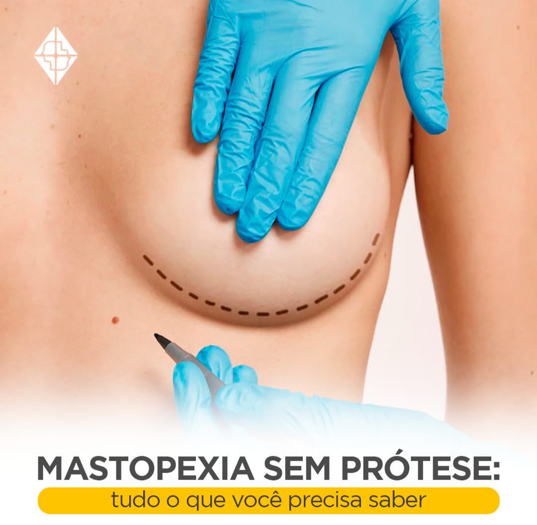 Imagem destaque de Mastopexia sem prótese: tudo que você precisa saber